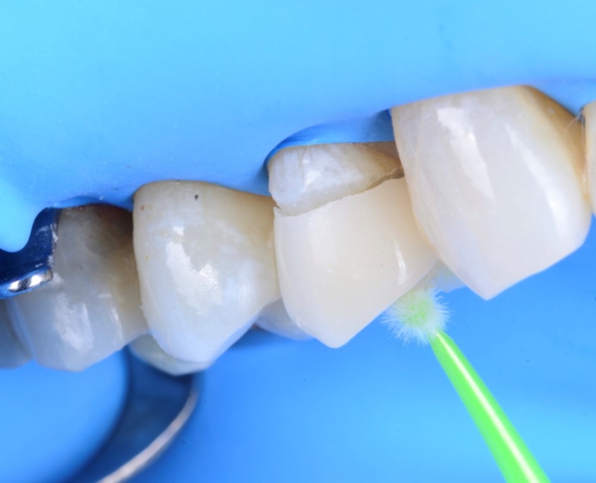 Adhesive and cosmetic dentistry