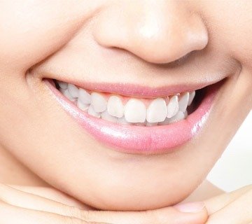 Sourire après un traitement de blanchiment des dents