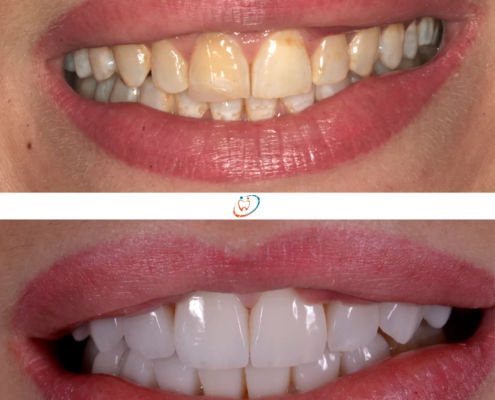 Avant/après de pose de facettes sur dents jaunies