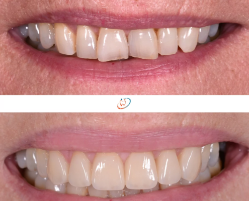 Avant/après la pose de facettes à des fins d'alignement des dents