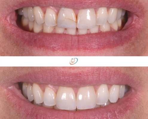 Avant/après de pose de facettes sur dents fissurées