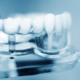 Modèle dentaire en plastique montrant des implants dentaires intégrés avec des couronnes, illustrant la structure et le placement des implants.