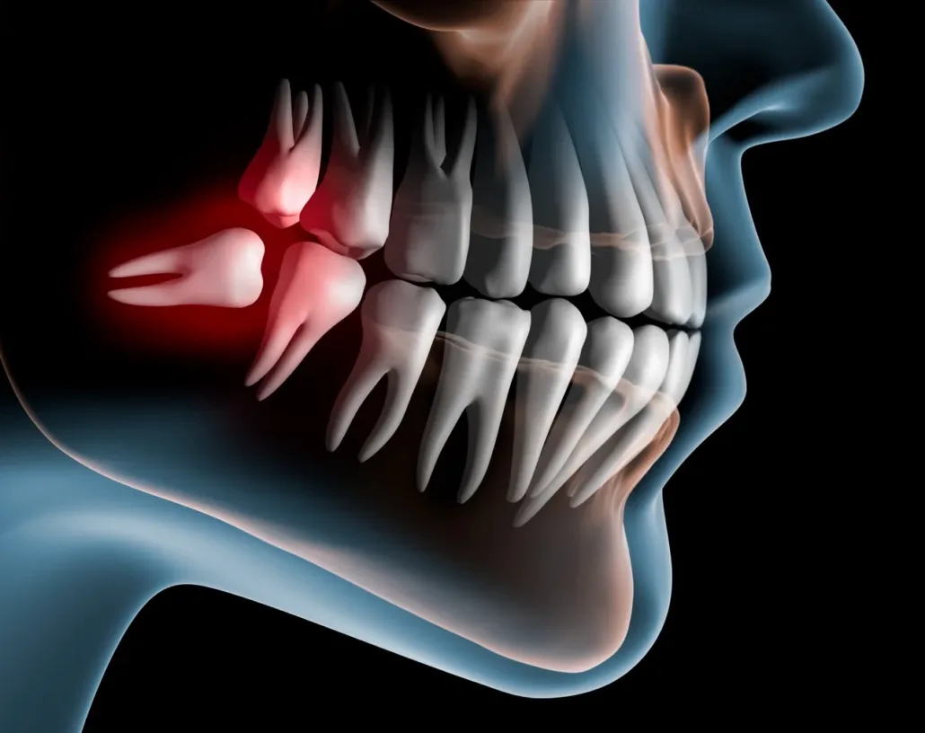 dents-de-sagesse-incluses-mont-sur-lausanne-D1DentalConcept