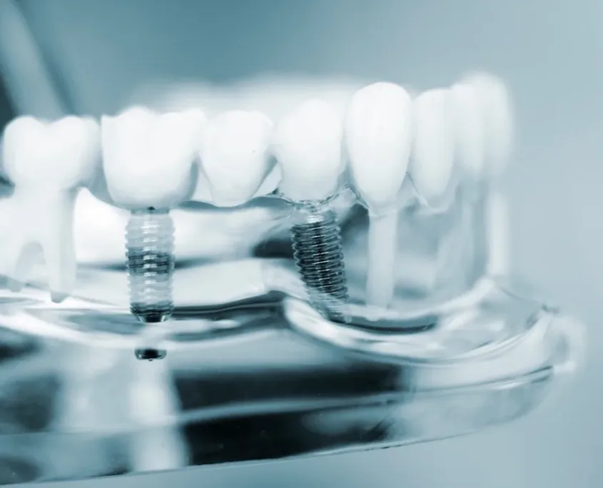 Dental implants